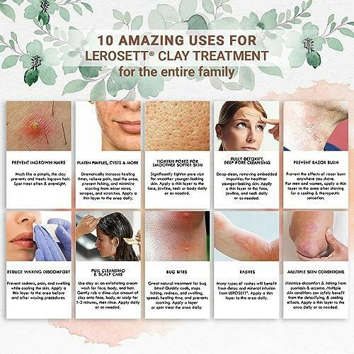 LEROSETT Spot Treatment & Clay Mask - Swedish Facial Clay for Acne, Oily & Congested Skin, Blemishes, Blackheads, Pimples, Ingrown Hairs, Tighten Pores. Fast-Drying. Natural. Vegan. 650+ Uses 3oz - The European Gift Store